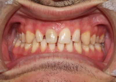 Spaced teeth before
