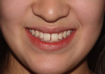 Spaced teeth before clear fixed braces Essex