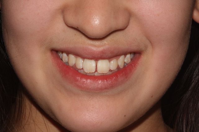 Spaced teeth before clear fixed braces Essex