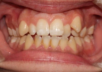 Crowded top and bottom teeth before clear fixed braces Essex fastbraces