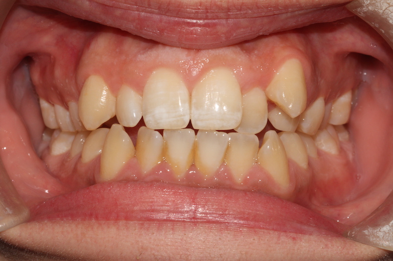 Crowded top and bottom teeth before clear fixed braces Essex fastbraces