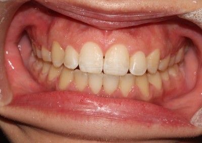 Crowded top and bottom teeth after clear fixed braces Essex fastbraces