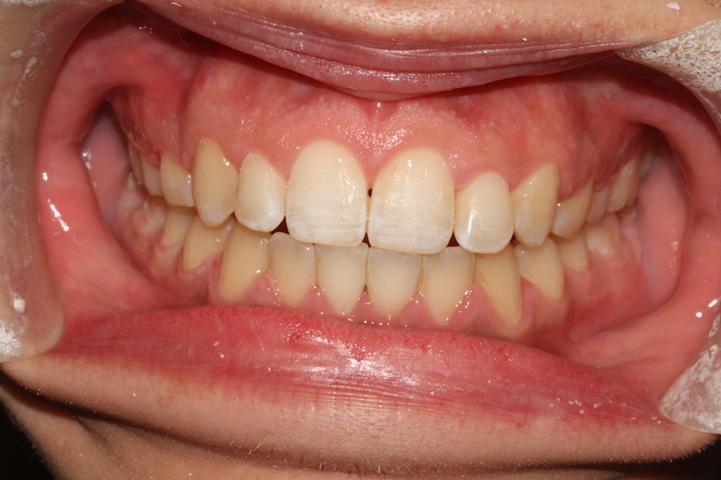 Crowded top and bottom teeth after clear fixed braces Essex fastbraces