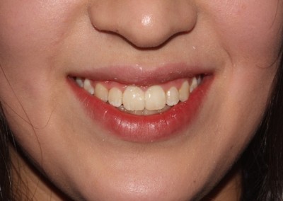 Spaced teeth after clear fixed braces Essex