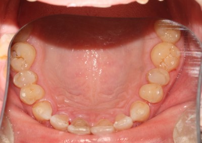 Spaced teeth after