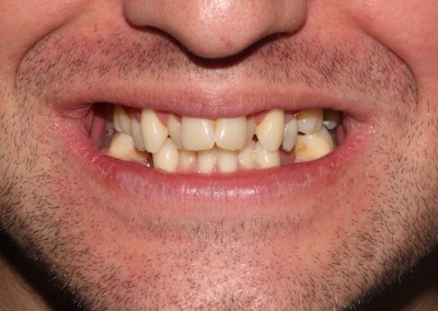 Adult braces before