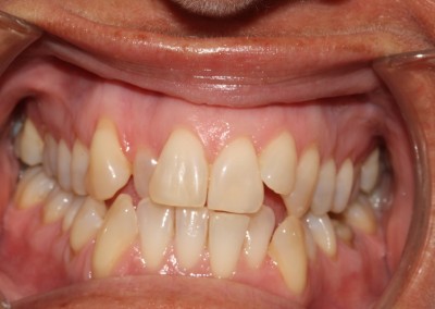 Crowded top and bottom teeth before clear fixed braces Essex