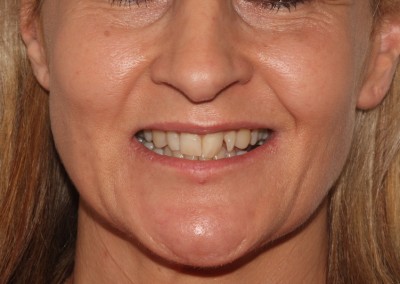 adult braces before