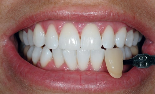 After Teeth Whitening After Teeth Whitening