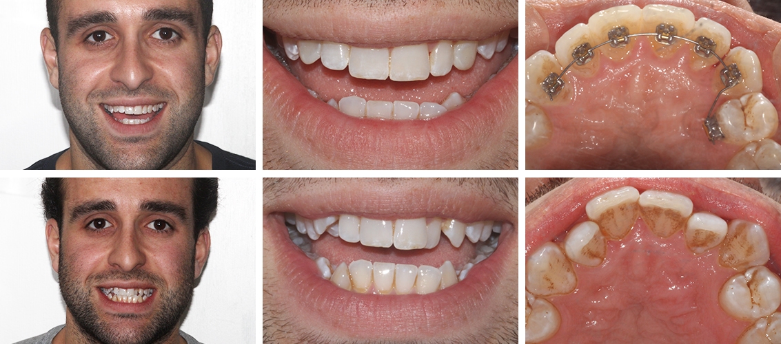 Lingual Braces before and after at street farm dental in Essex Lingual Braces before and after at street farm dental in Essex