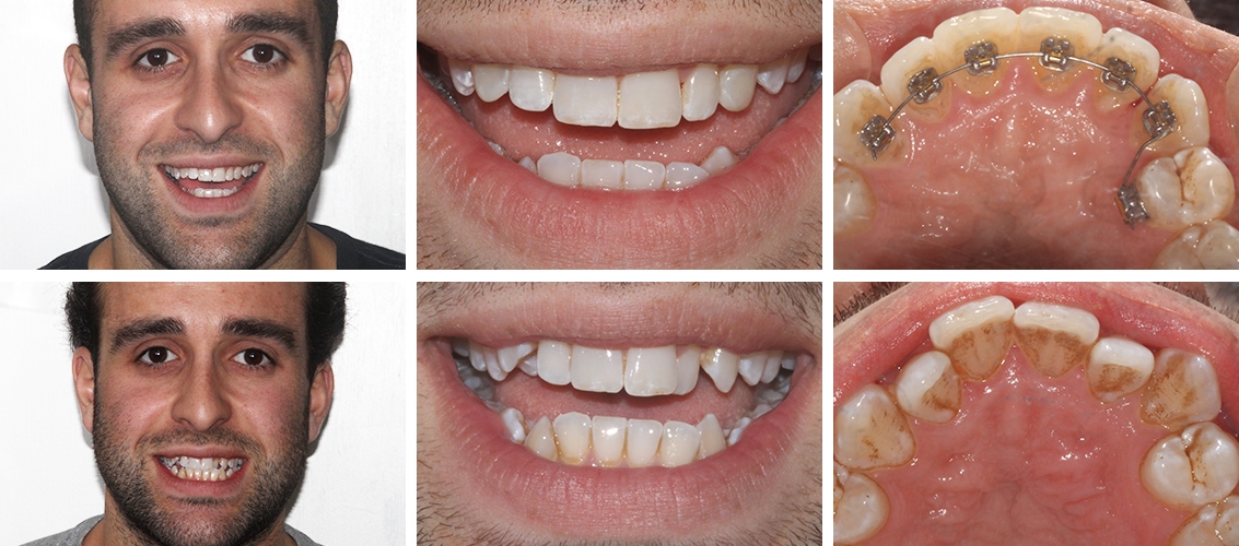 Lingual Braces before and after at street farm dental in Essex