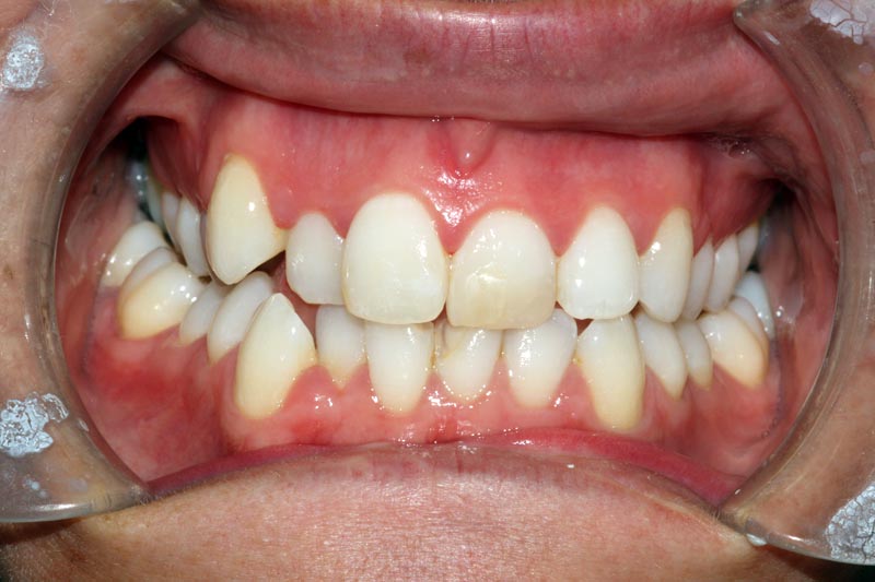 Before Braces At Street farm Dental Essex Before Braces At Street farm Dental Essex