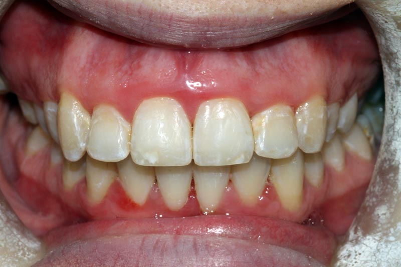 After Braces At Street farm Dental Essex