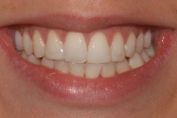 Composite Bonding Essex | Teeth Bonding Thurrock | Dental Bonding
