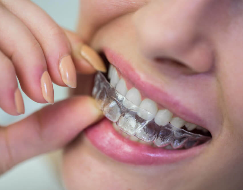 invisalign-treatment-street-farm-dental