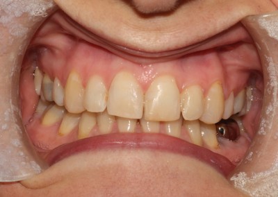 adult braces after