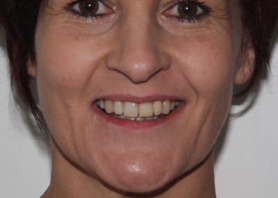 adult braces after