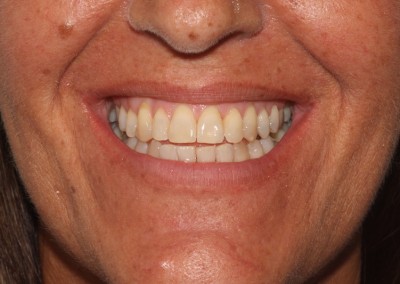 Crowded top and bottom teeth after clear fixed braces Essex