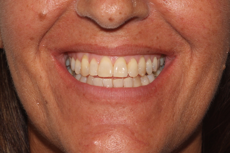 Crowded top and bottom teeth after clear fixed braces Essex