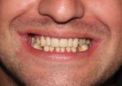 Adult braces after