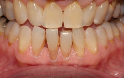 Veneer Case Lower Tooth