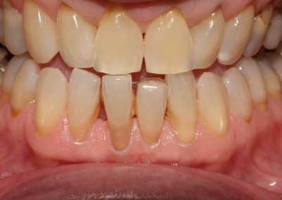 Veneer Case Lower Tooth