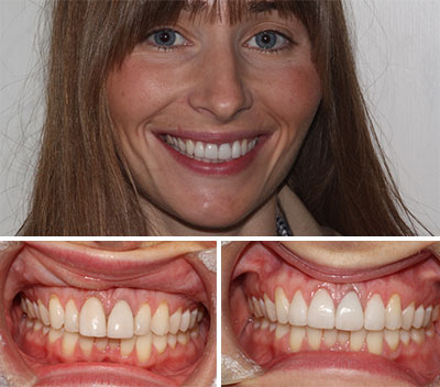 Dental Veneers Essex Thurrock Grays Before & After