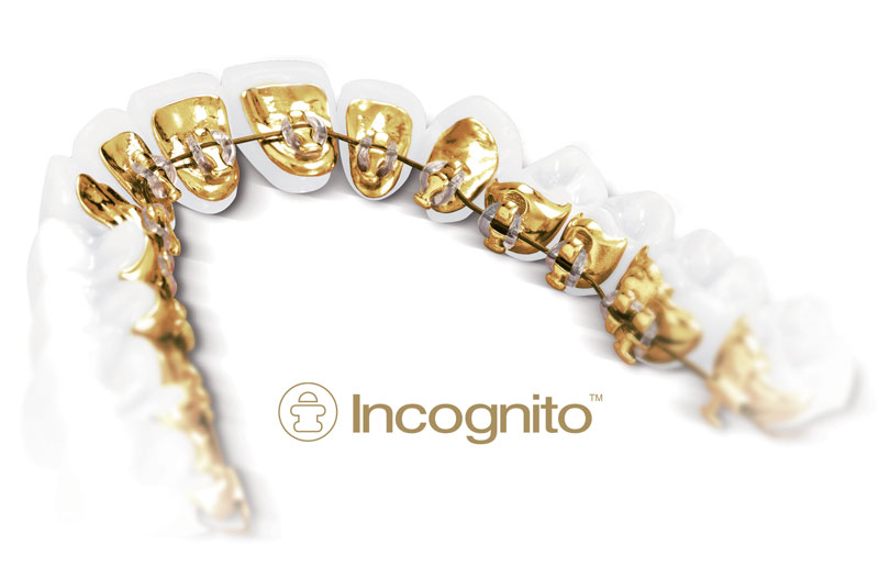 Cost of Lingual braces Cost of Lingual braces