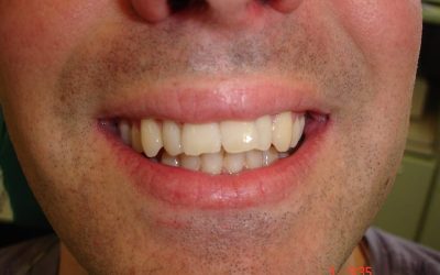 Invisalign Case 1