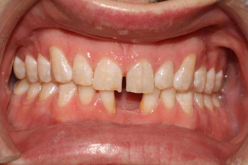 Missing front tooth dental implants essex before