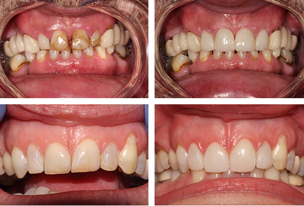 Dental Veneers Essex, Before and After Dental Veneers Essex