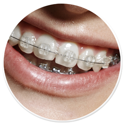 Fixed Braces South Ockendon Essex