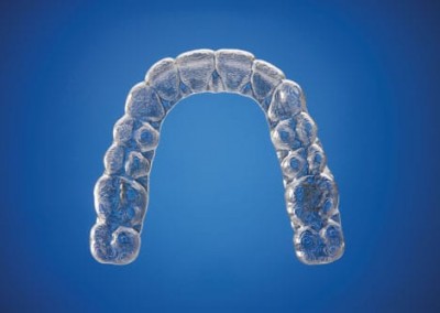 Invisalign Clear Brace Essex