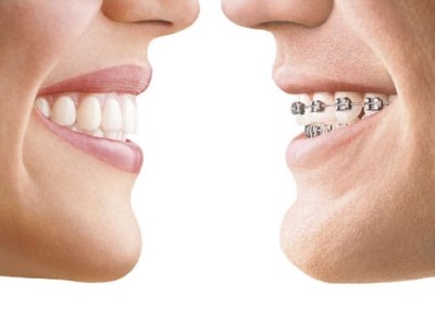 Invisalign Essex