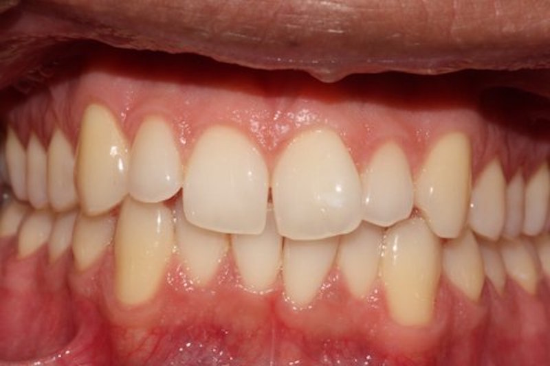 Fixed Braces Essex | Braces for adults | Thurrock Upminster Essex