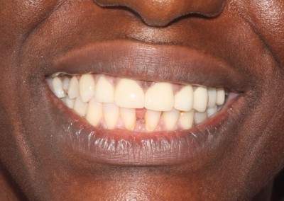 Iluma - Upper Veneers and Whitening