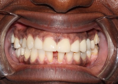 Iluma - Upper Veneers and Whitening