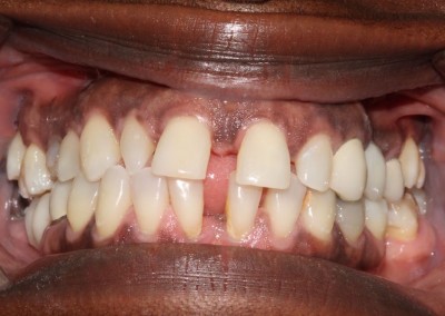 Iluma - Upper Veneers and Whitening