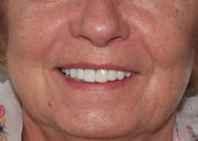 Maureen Implants and Crowns and whitening