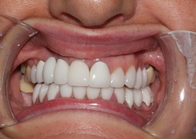 Mel, Implants, Crowns and Veneers