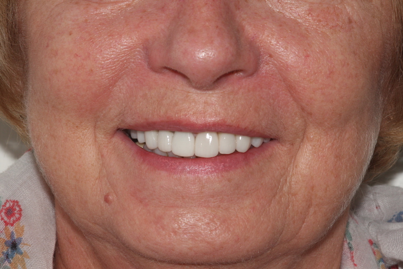 After Smile Makeover Essex