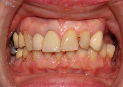 Maureen Implants and Crowns and whitening