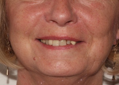 Maureen Implants and Crowns and whitening