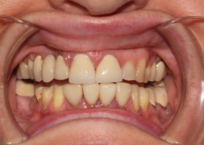 Mel, Implants, Crowns and Veneers