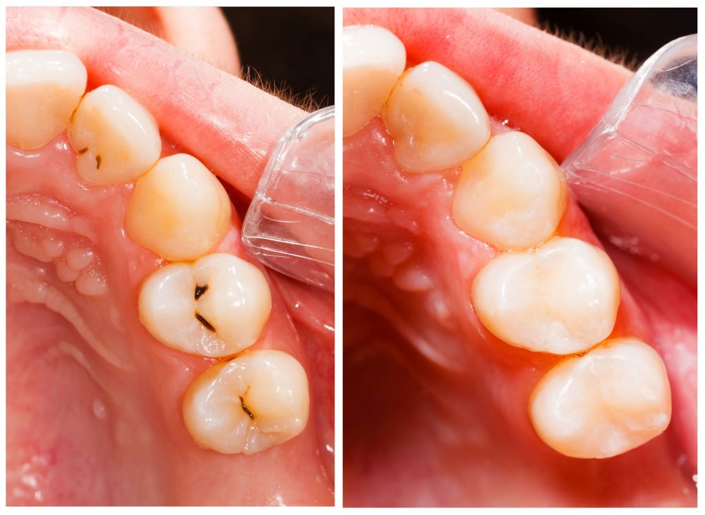 White Fillings Dental Fillings Cost NHS Grays Thurrock Essex